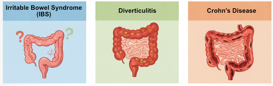 Irritable Bowel Syndrome (IBS), Diverticulitis, Crohn's disease